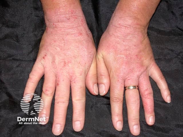 Контактный дерматит, вызванный резиной