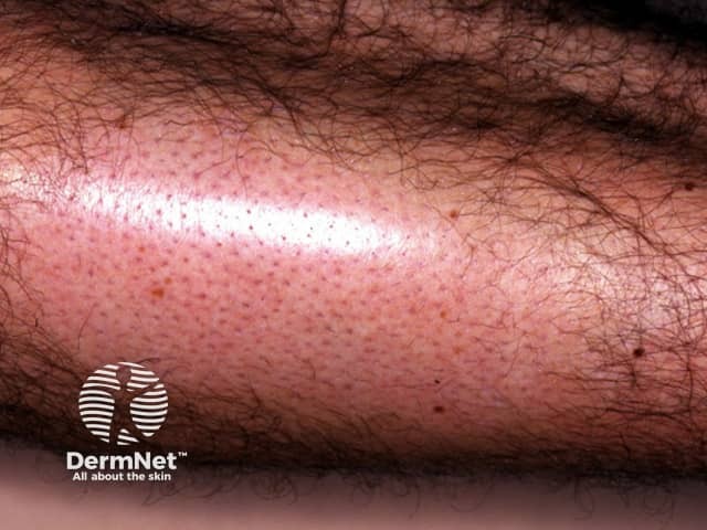 Муцинозная алопеция: сгруппированные фолликулярные папулы на волосистой части головы