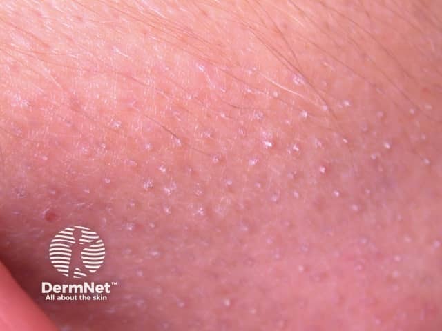 Муцинозная алопеция: клиническая картина фолликулярного муциноза