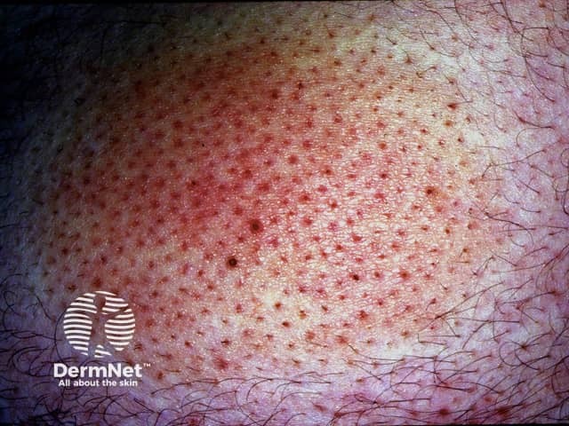 Муцинозная алопеция: эритематозная инфильтрированная бляшка в височной области
