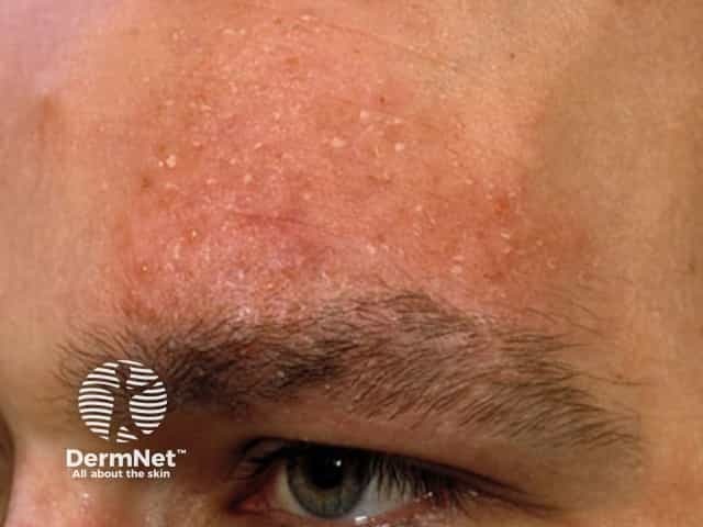 Муцинозная алопеция: поражение кожи лица и шеи