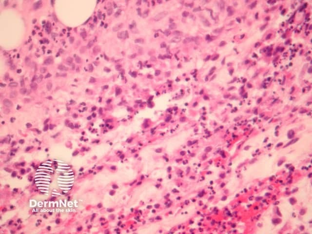 Рисунок 3. Интерстициальный инфильтрат в глубокой дерме и гиподерме.