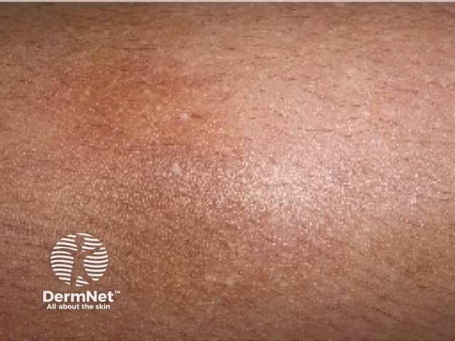 Макрофотография изменений пигментации кожи голени