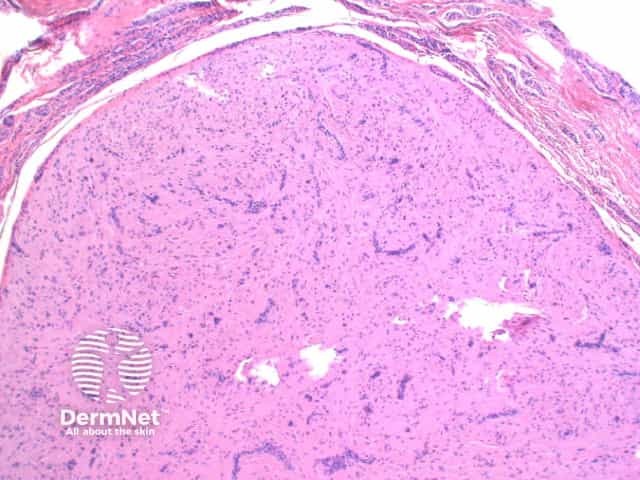 Рисунок 2. Среднее увеличение: переплетающиеся пучки гладкомышечных клеток вокруг сосудов.