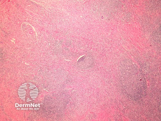 Рисунок 1. Выраженная васкуляризация и воспалительная инфильтрация дермы при малом увеличении.
