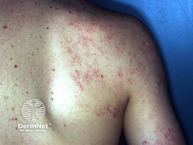 Серпигинозная ангиома: группирующиеся точечные сосудистые элементы с серпигинозным паттерном