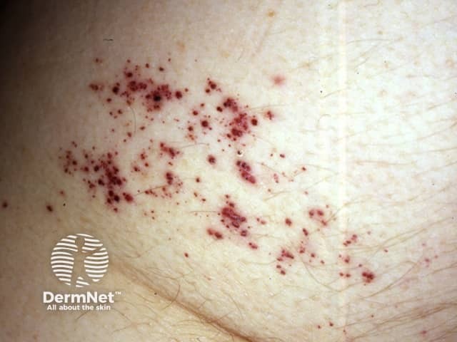 Серпигинозная ангиома на коже нижней конечности