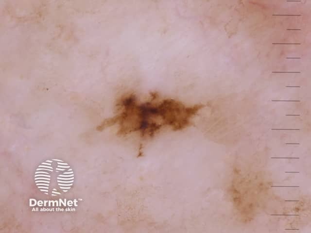 Дерматоскопическая картина угловатых линий при меланоме небольшого размера