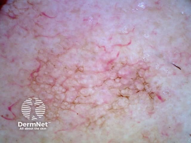 Угловатые линии при дерматоскопии актинического кератоза