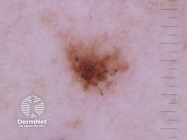 Дерматоскопическая картина угловатых линий при меланоме малых размеров