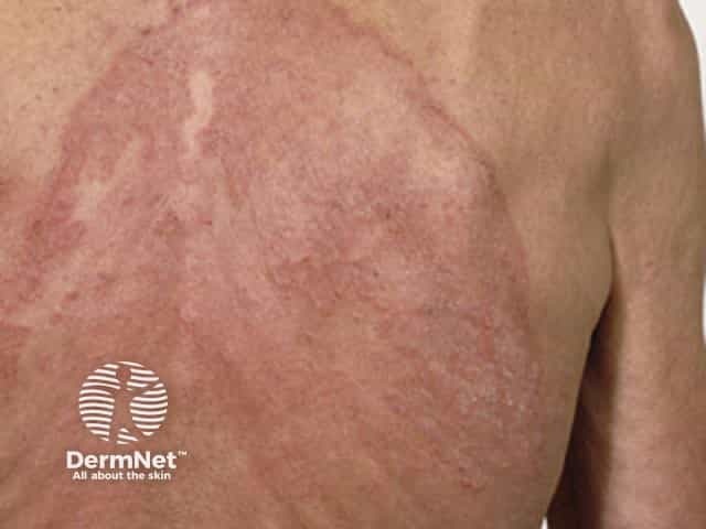 Распространенный микоз гладкой кожи (tinea corporis), прогрессирующий на фоне перорального приема тербинафина, должен вызывать настороженность в отношении резистентности к антимикотикам