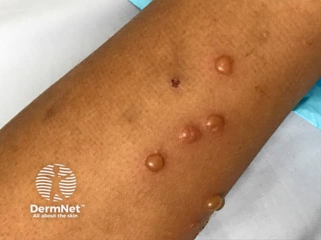 Буллезные элементы после укусов насекомых