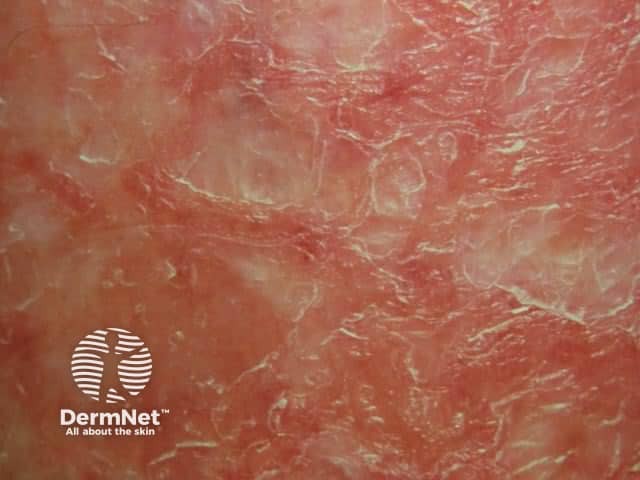 Трещиновидная экзема (Eczema craquelé)