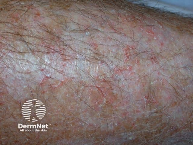 Трещиновидная экзема (Eczema craquelé)