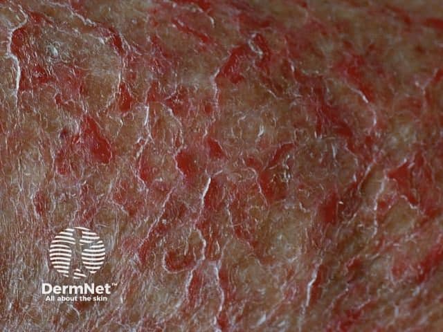 Трещиновидная экзема (Eczema craquelé)