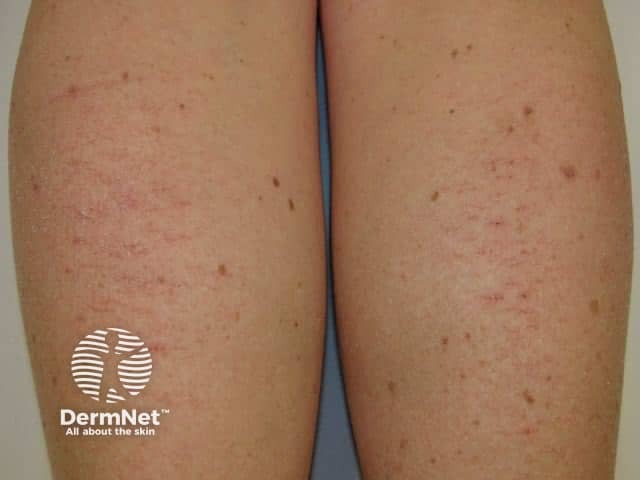 Трещиновидная экзема (Eczema craquelé)