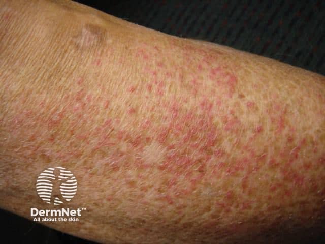 Трещиновидная экзема (Eczema craquelé)