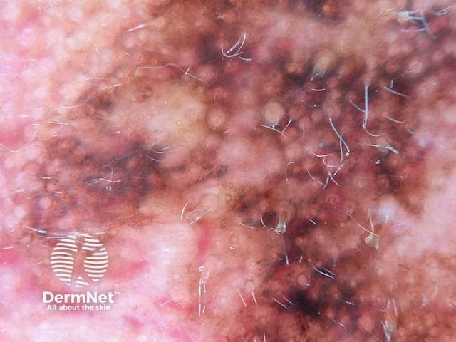 Асимметричная пигментация фолликулярных устьев при дерматоскопии лентиго-меланомы