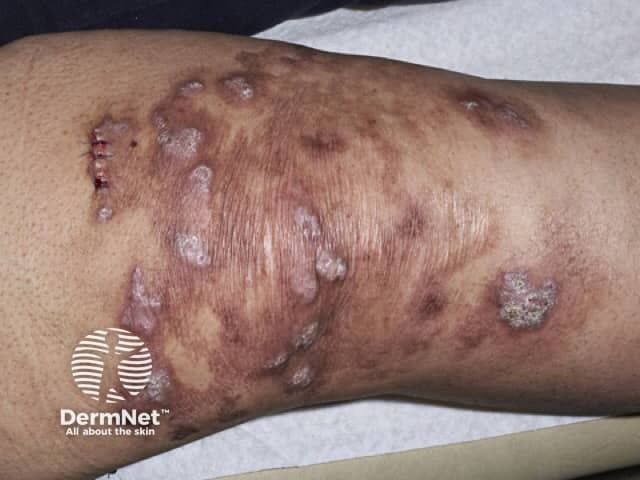 Споротрихоидная форма инфекции Mycobacterium marinum