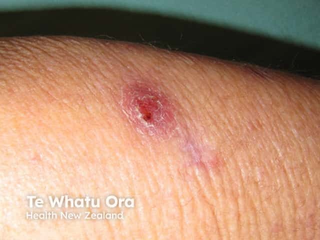 Инфекция Mycobacterium abscessus