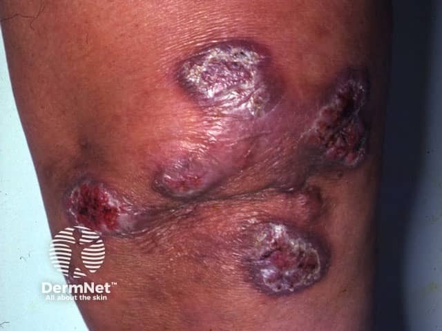 Инфекция Mycobacterium marinum