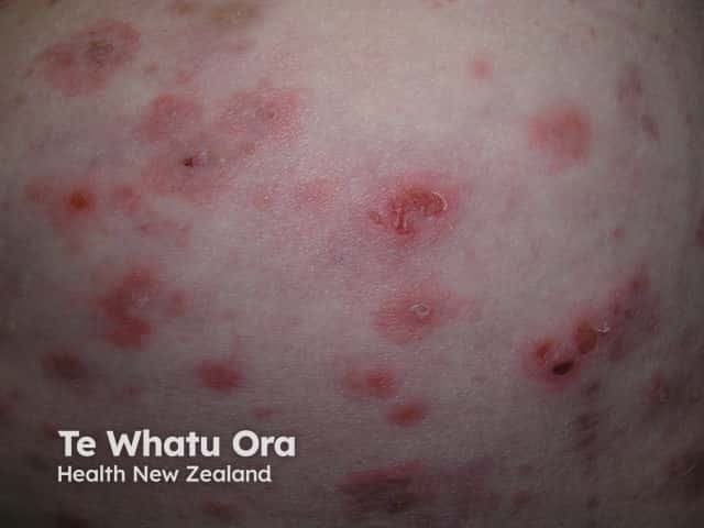 Листовидная пузырчатка (Pemphigus foliaceus)