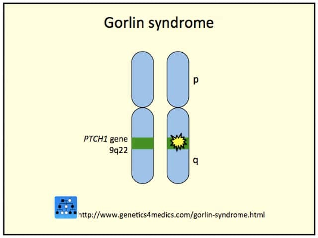 Генетика синдрома базальноклеточного невуса (изображение предоставлено Genetics 4 Medics)