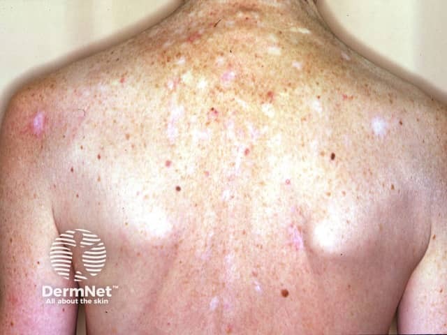 Множественные базальноклеточные карциномы (базалиомы) и рубцы