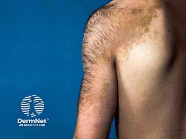 Пигментация и гипертрихоз при невусе Беккера