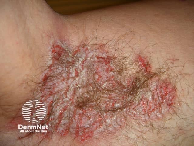 Болезнь Хейли — Хейли в подмышечной впадине