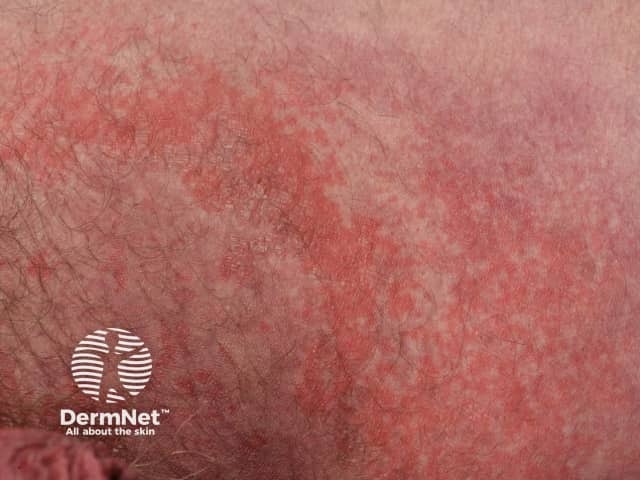 Гранулярный паракератоз, индуцированный контактом с бензалкония хлоридом