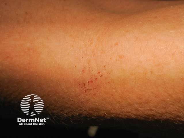 Брахиорадиальный зуд, свежие экскориации на предплечье