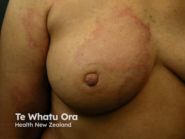 Рожеподобный рак (carcinoma erysipeloides)