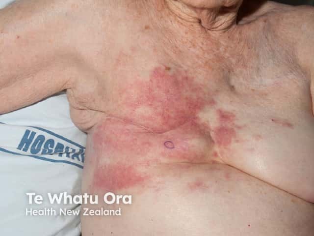 Рожеподобный рак (carcinoma erysipeloides)
