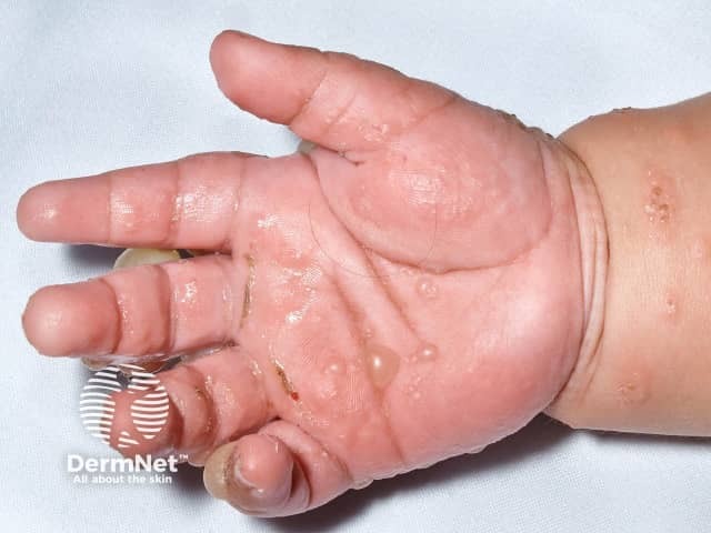 Буллезный пемфигоид у детей
