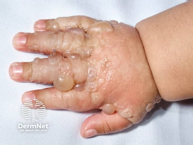 Буллезный пемфигоид у детей