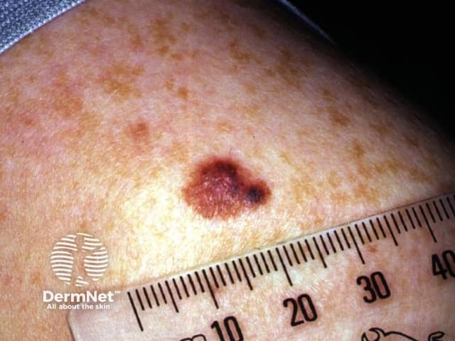 Поверхностно распространяющаяся меланома у подростка 14 лет