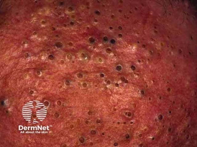 Характерные комедоны при хлоракне