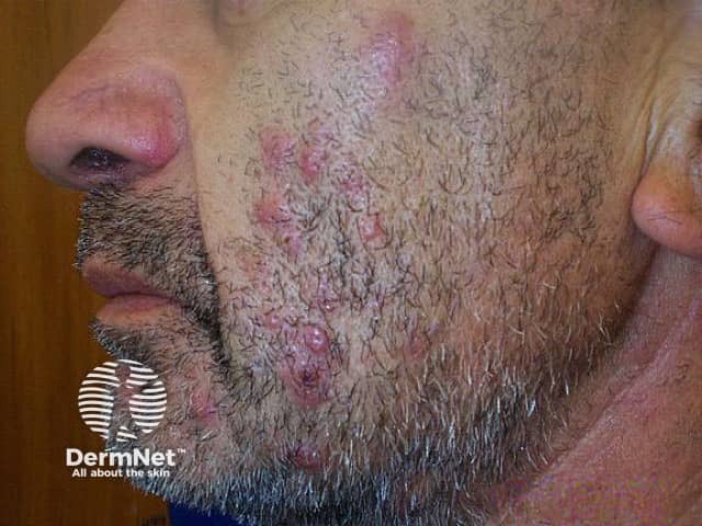 Вторичные воспалительные элементы