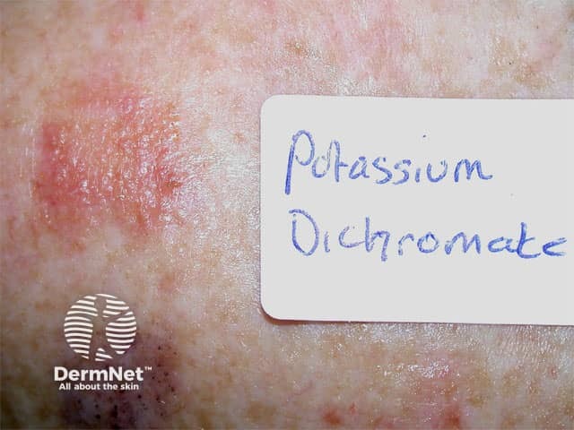 Положительный результат аппликационного теста (патч-теста) с дихроматом калия