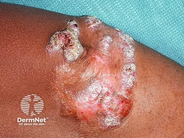 Макрофотография очага при хромобластомикозе