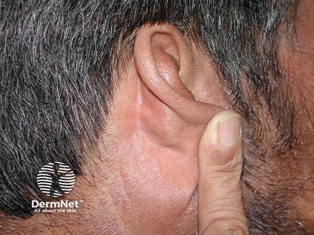 Хронический актинический дерматит шеи: обратите внимание на интактность экранированных от света ретроаурикулярных областей