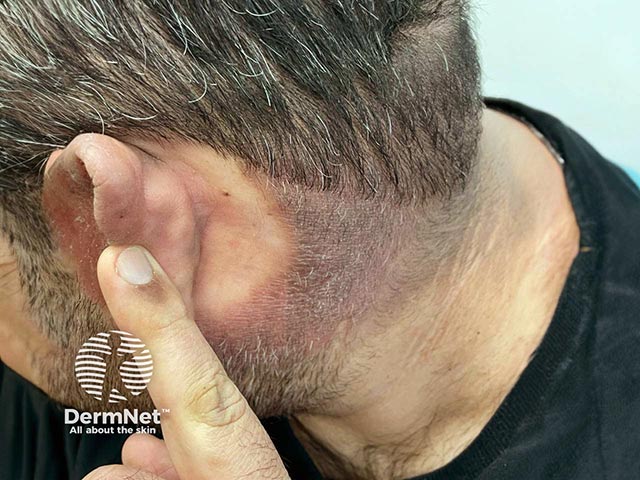 Пигментная форма хронического актинического дерматита: обратите внимание на четкую границу по линии ворота и интактность зон позади и снизу от ушных раковин