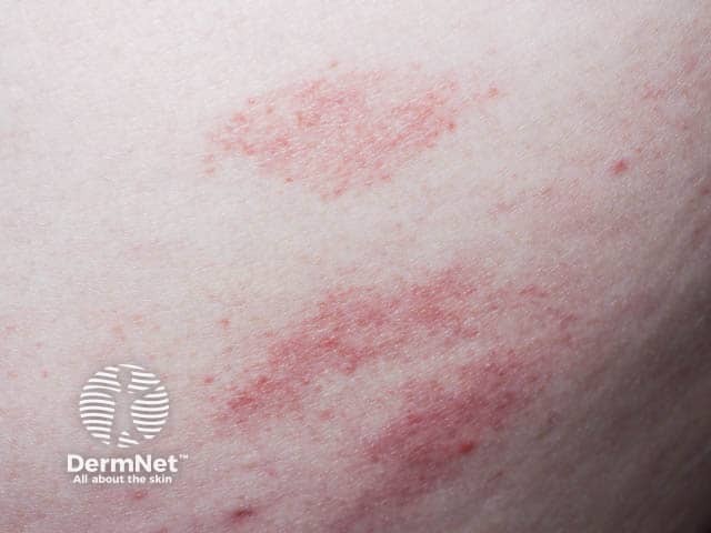 Пальцевидные розовые шелушащиеся пятна при хроническом поверхностном шелушащемся дерматите