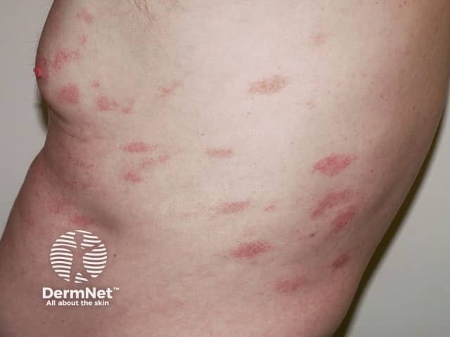 Пальцевидные розовые шелушащиеся пятна при хроническом поверхностном шелушащемся дерматите