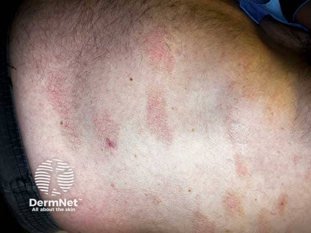 Пальцевидные высыпания при хроническом поверхностном шелушащемся дерматите на коже грудной клетки и живота