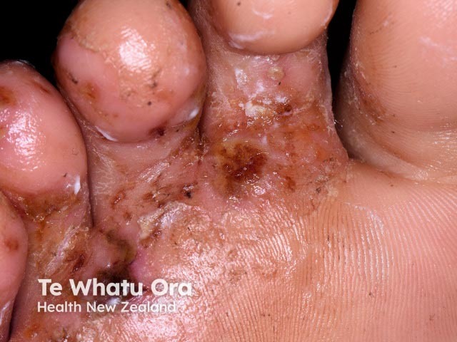 Микоз стоп (Tinea pedis)