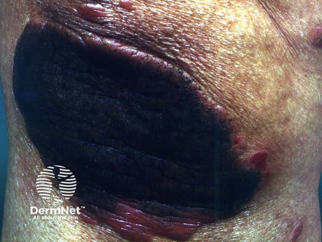 Аппликация каменноугольного дегтя при бляшечном псориазе