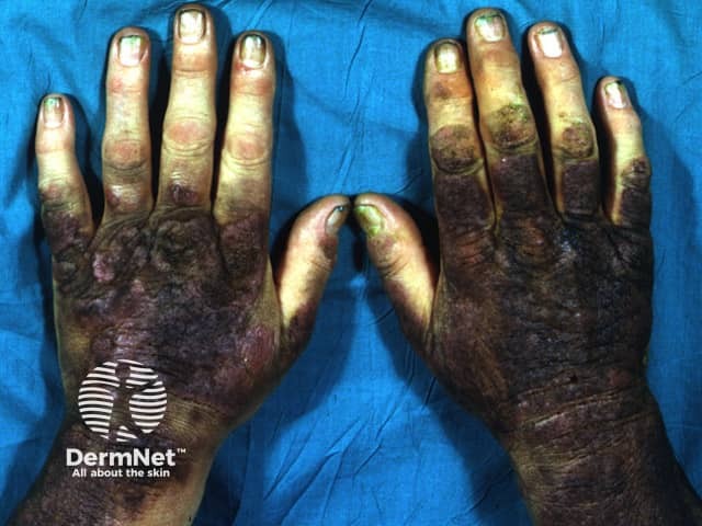 Каменноугольный деготь: консистенция и особенности наружного нанесения