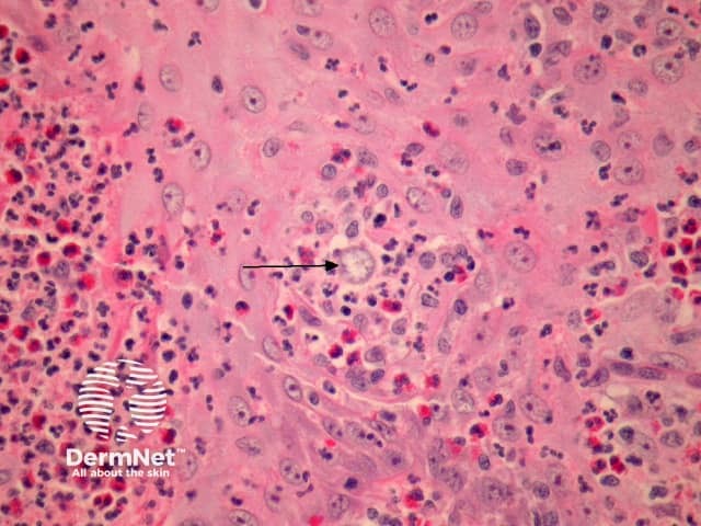 Рисунок 2. Сферулы Coccidioides immitis при высоком увеличении (отмечены стрелкой).